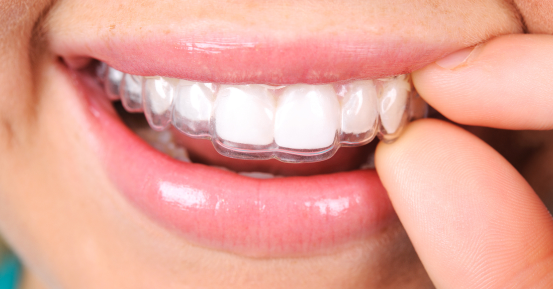 Image of someone with a straight smile wearing a removable retainer to prevent teeth movement at night.