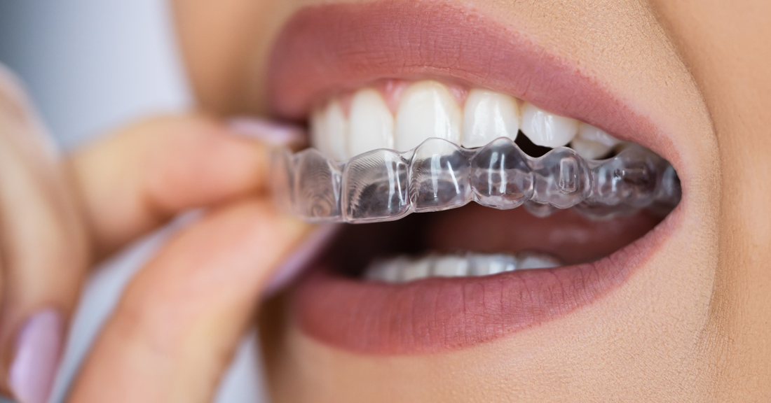 Image of someone with clear aligners during Invisalign treatment to fix an overbite.