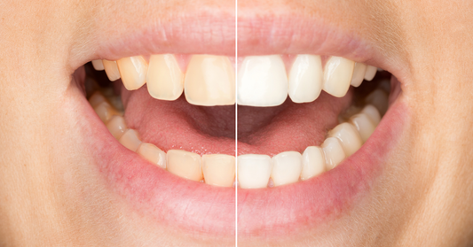Before and after image of a teeth bleaching procedure.
