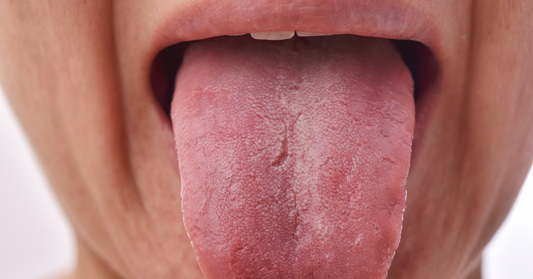 Image showing someone with a dry tongue, related to the query, "Best mints for dry mouth" for those with clear aligners.
